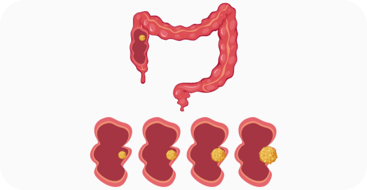 What is Bowel Cancer?