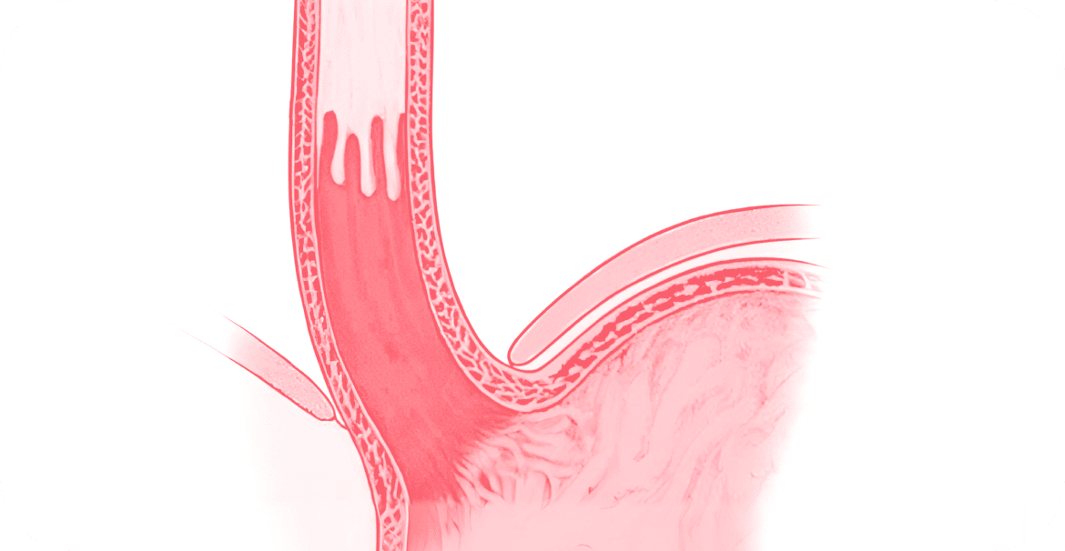 What is Barrett’s Oesophagus?