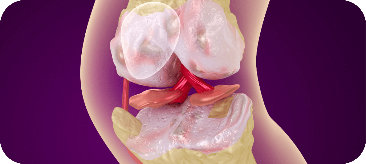 Avoiding Complications of Coeliac Disease