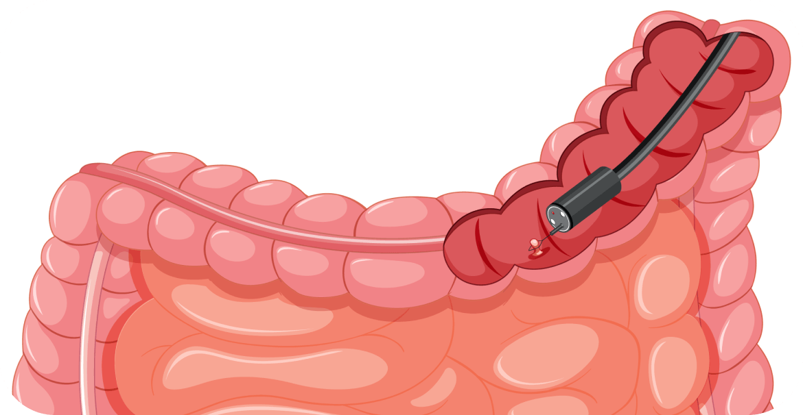 Diagnosis and Staging