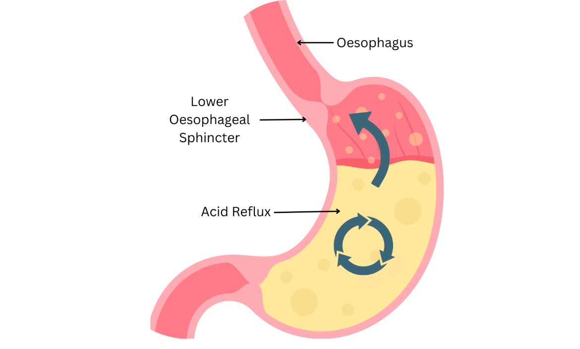 Factors leading to Barrett's Oesophagus?
