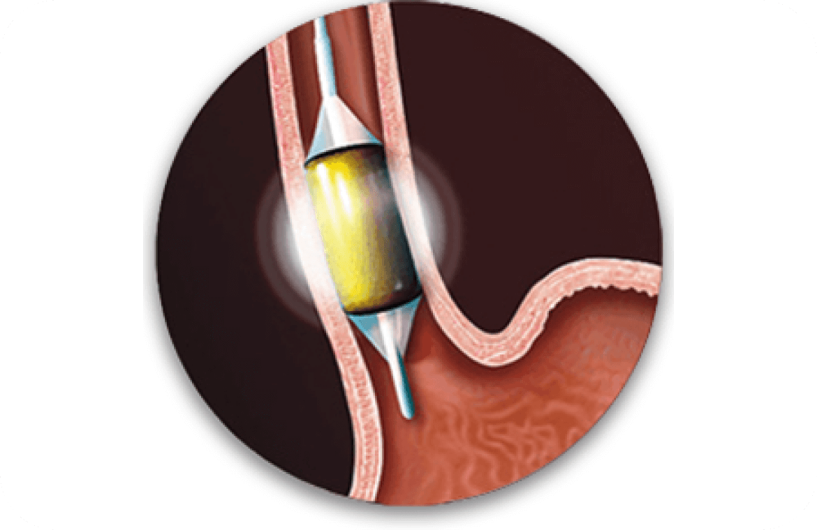 Radio Frequency Ablation (RFA)