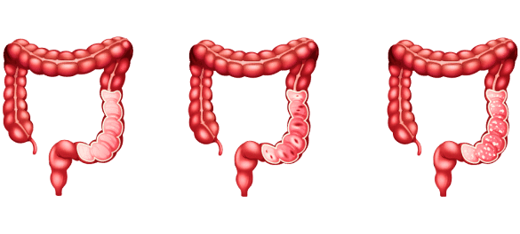 Types of Constipation