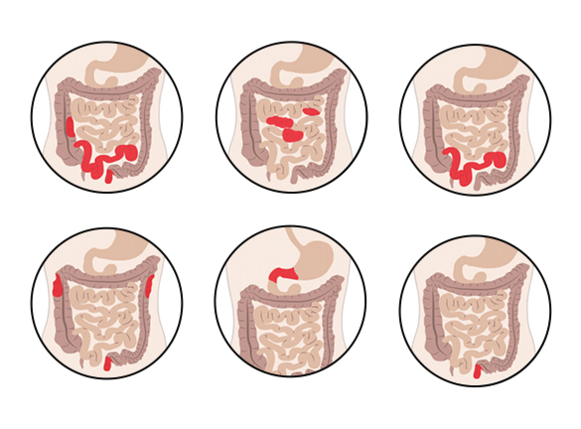 Types of Crohn’s Disease
