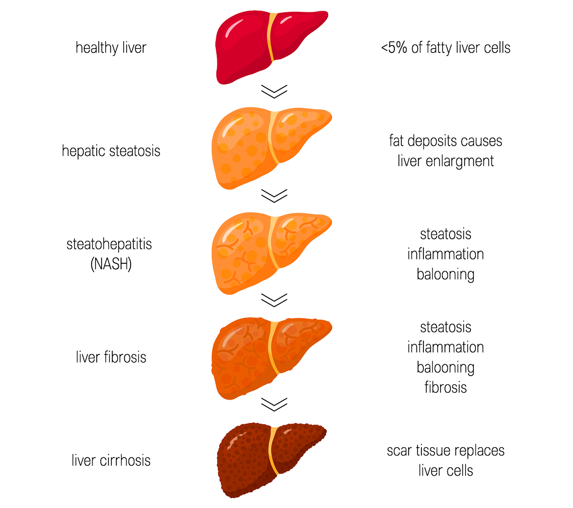 Stages of Fatty Liver Disease