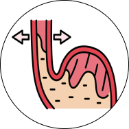 Silent acid reflux disease